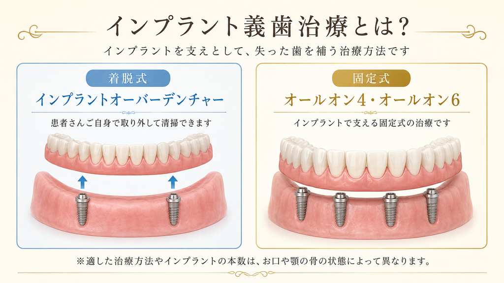 インプラント義歯治療の着脱式と固定式の違い